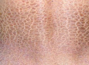 鱼鳞病的预防护理要怎么做