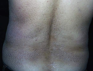 哪些因素会使鱼鳞病症状加重