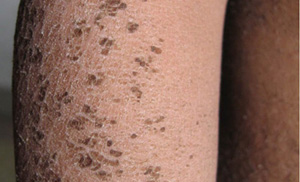 患了鱼鳞病应该怎么办呢