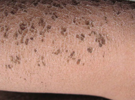 治疗鱼鳞病的较佳方法是什么