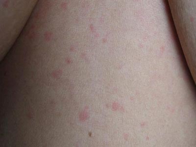 皮肤荨麻疹预防从哪儿着手