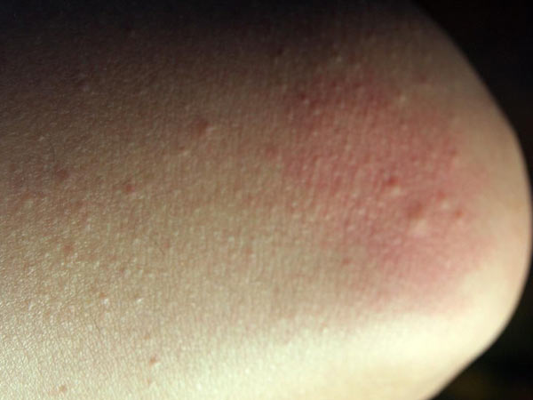 季节性皮肤过敏是什么症状