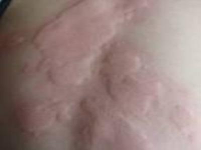 新生儿风疹病毒图片