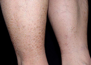 引发鱼鳞病的原因有哪些