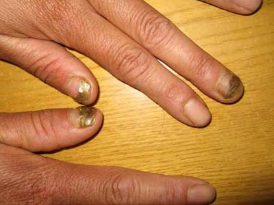 灰指甲应该怎么判断