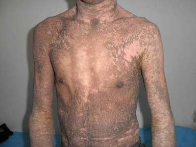 治疗鱼鳞病的医院