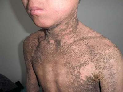 鱼鳞病是牛皮癣吗