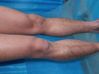 鱼鳞病会蔓延全身吗