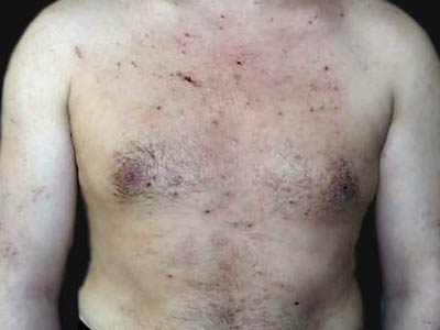 脂溢性皮炎的症状都是哪些