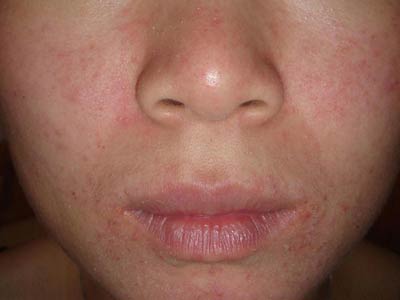 脂溢性皮炎的发病原因是哪些