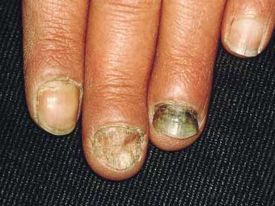 灰指甲患者注意事项有哪些