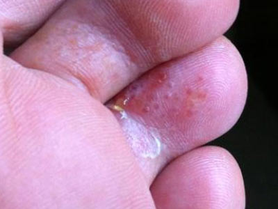 水泡型脚气怎么根治