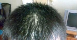 ͷƤ֬����Ƥ�׵Ļ���Ҫ��