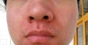 �沿֬����Ƥ�׵Ľ���