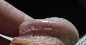 ��Ƥ�׵�֢״ͼƬ