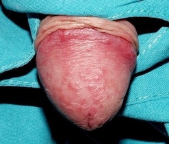 ��Ƥ��֢״������ʲô