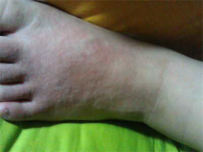 小孩脚气怎么治