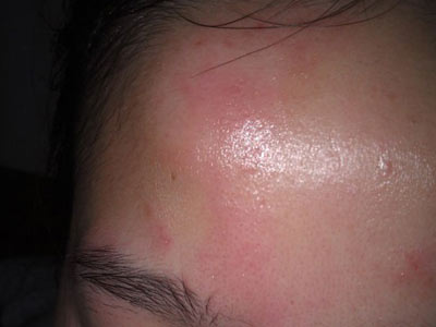 Ƥ�׵�ԭ��֢״