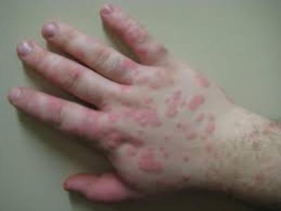 过敏性荨麻疹怎么预防