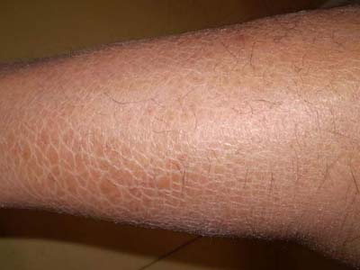 小腿皮肤干燥龟纹状