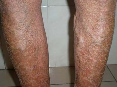 小腿皮肤干燥蜕皮