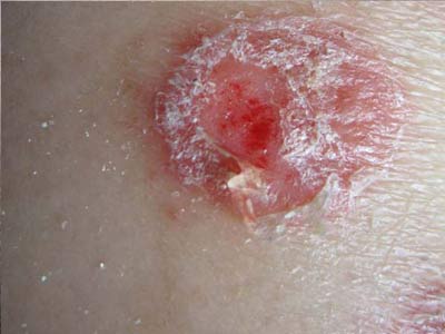 青少年得了牛皮癣的具体症状