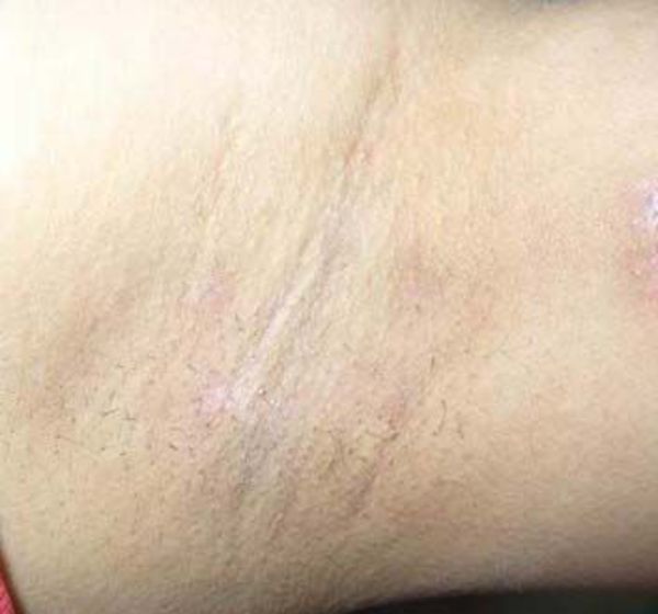 治疗腋臭的误区
