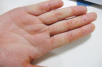 手部出现湿疹,患者较痛苦的莫过于指关节之间瘙痒难耐,这让她们很是