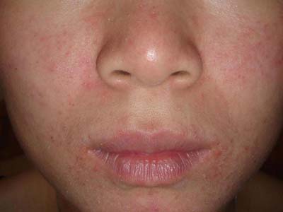 ����Ƥ�׶���ܺ�