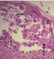 预防生殖器疱疹的方法都是什么