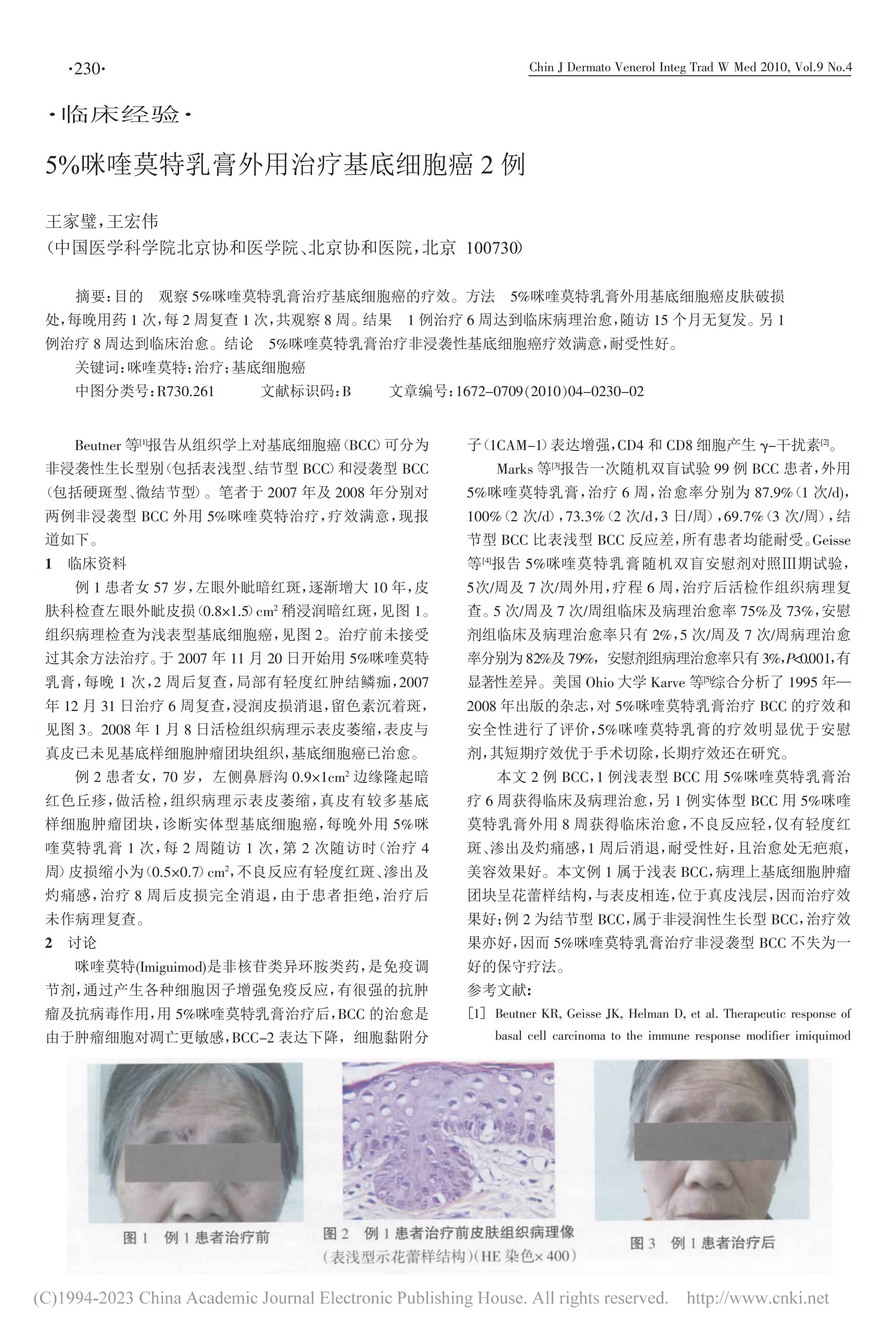 5%咪喹莫特乳膏外用治疗基底细胞癌2例