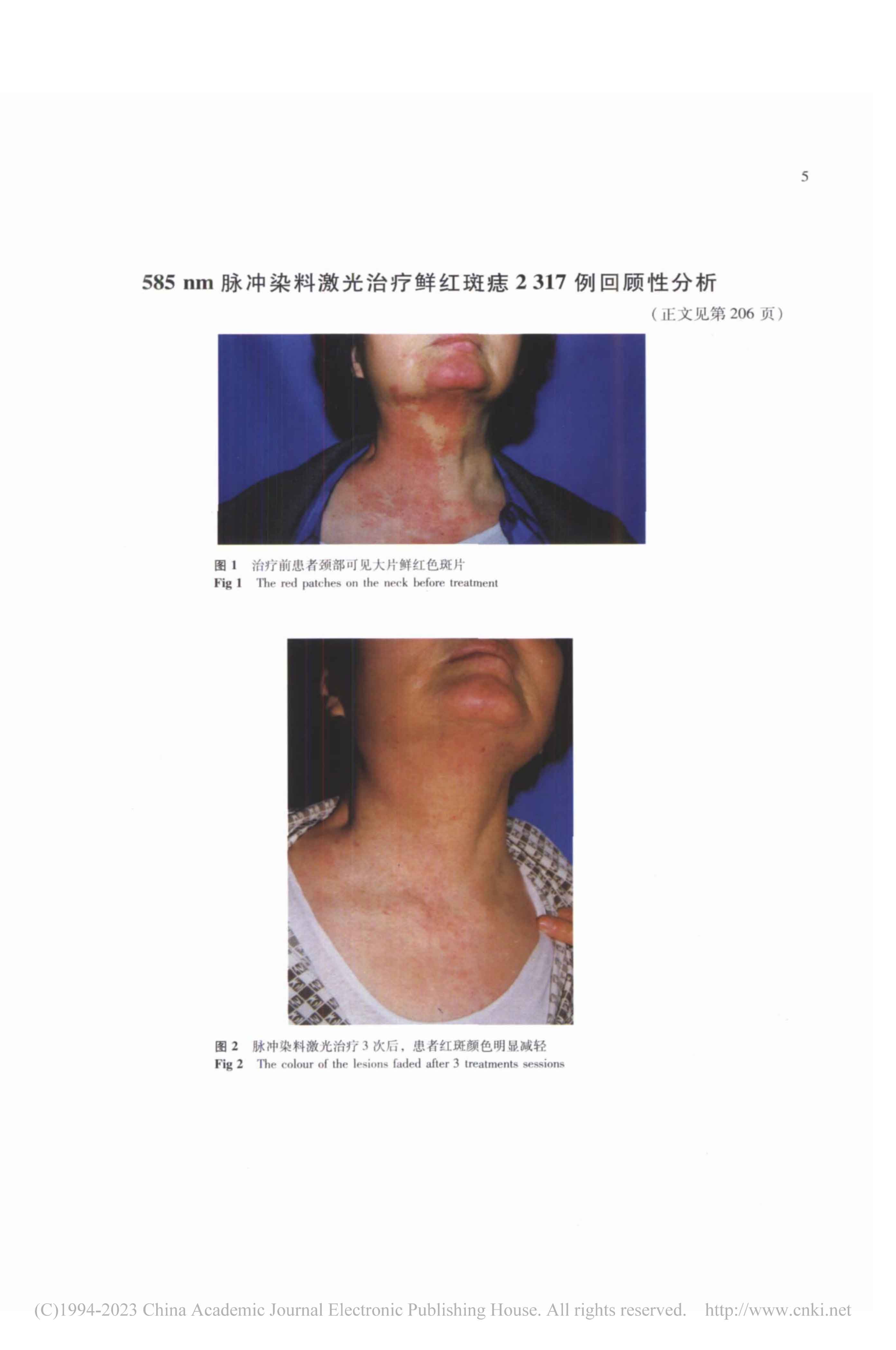 585nm脉冲染料激光治疗鲜红斑痣2317例回顾性分析
