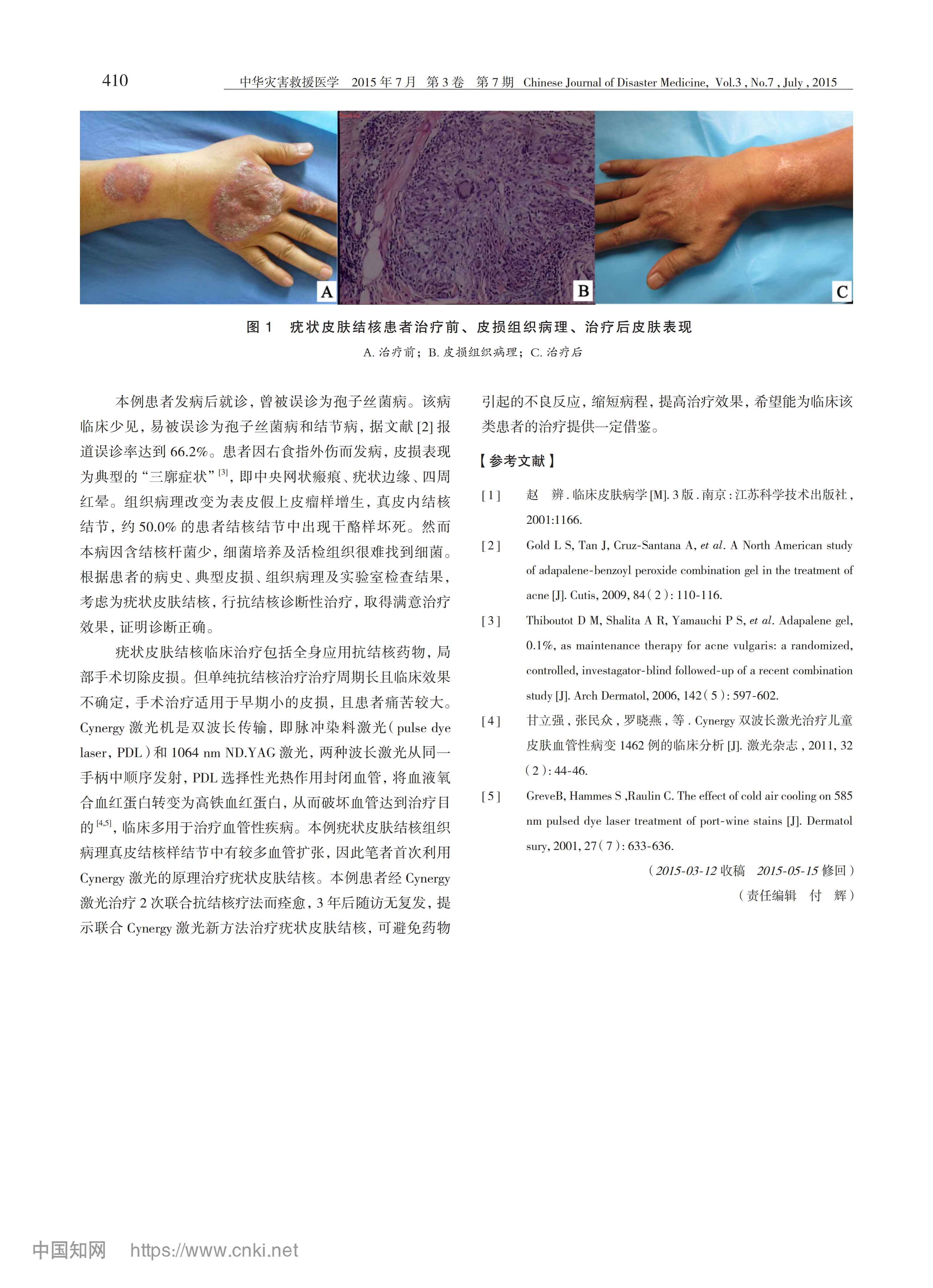 Cynergy双波长激光治疗疣状皮肤结核1例