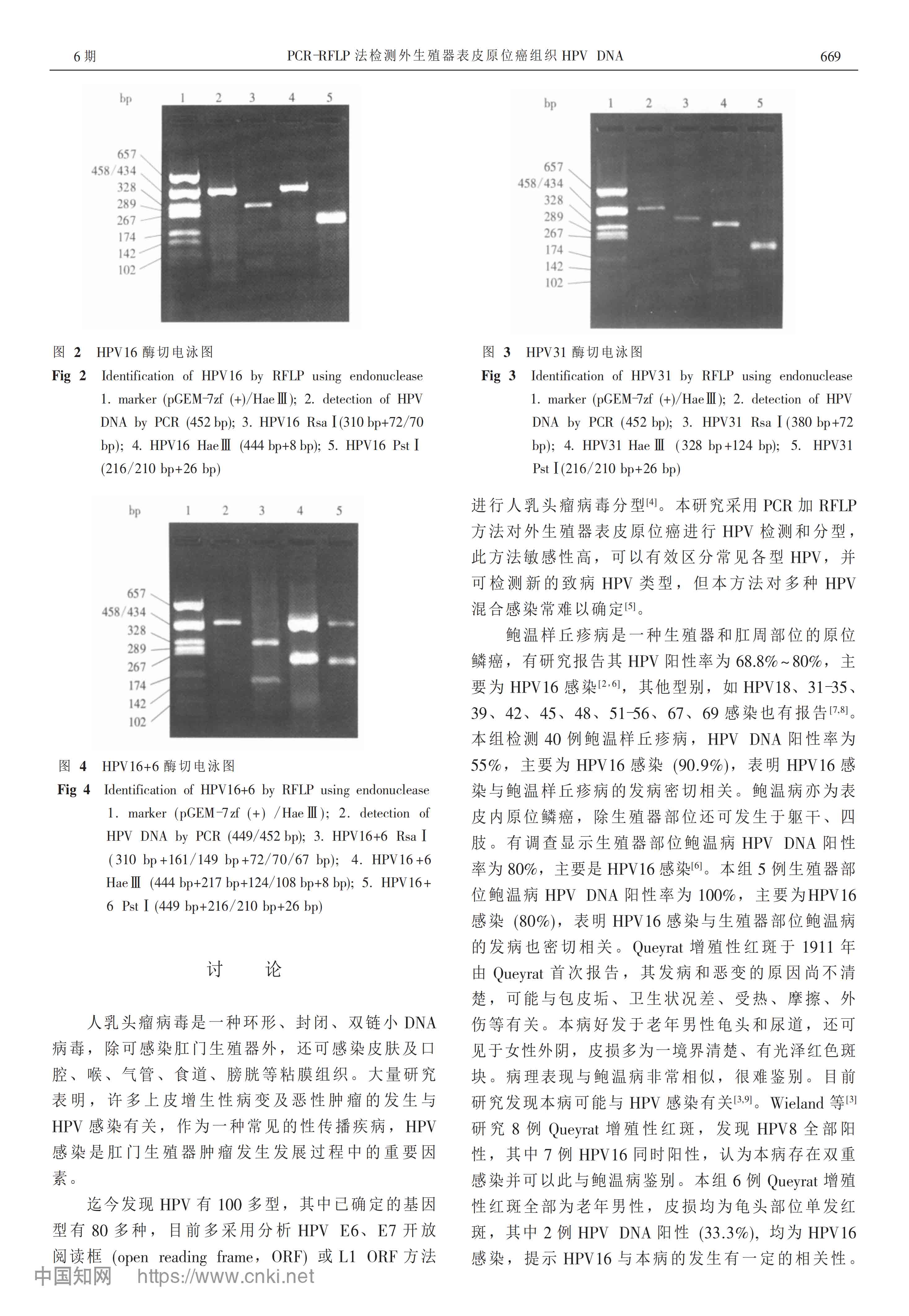 PCR-RFLP法检测外生殖器表皮原位癌组织HPV_DNA