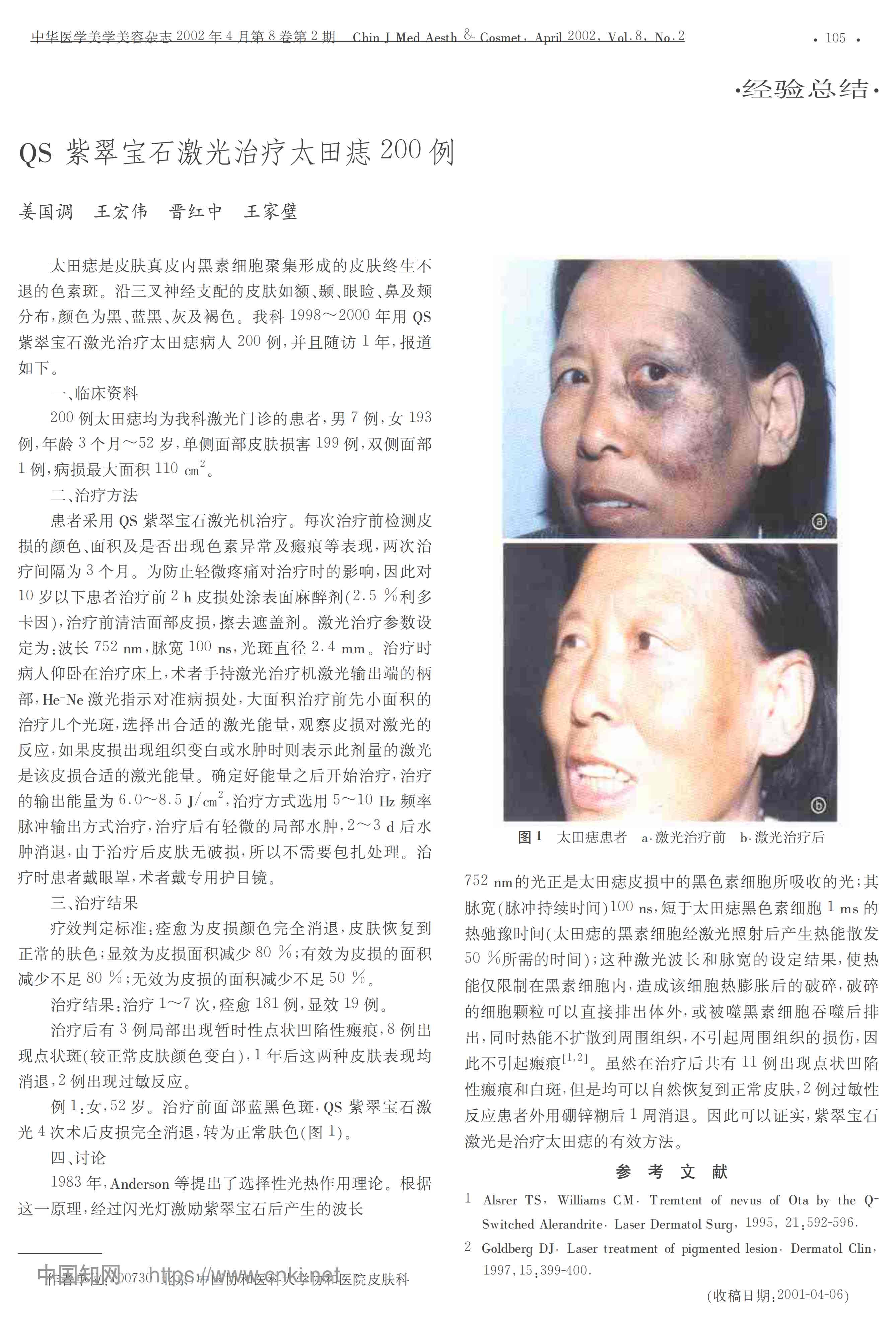 QS紫翠宝石激光治疗太田痣200例