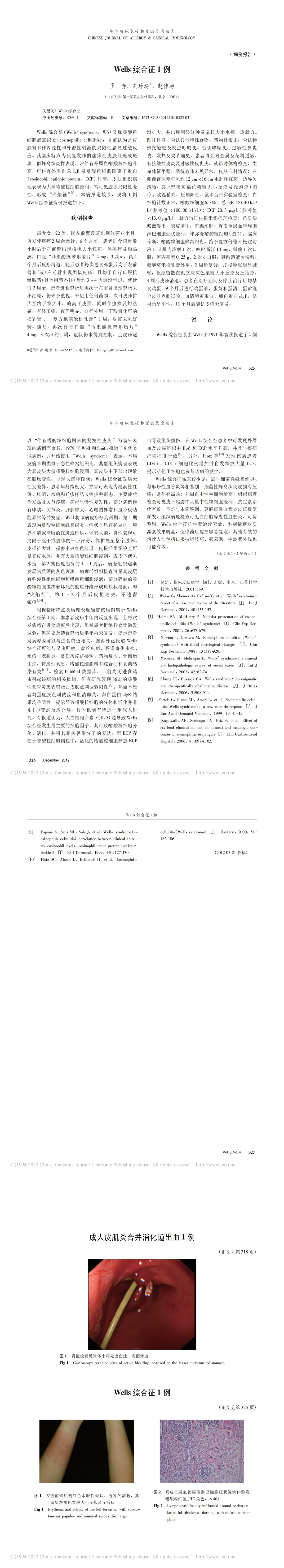 Wells综合征1例