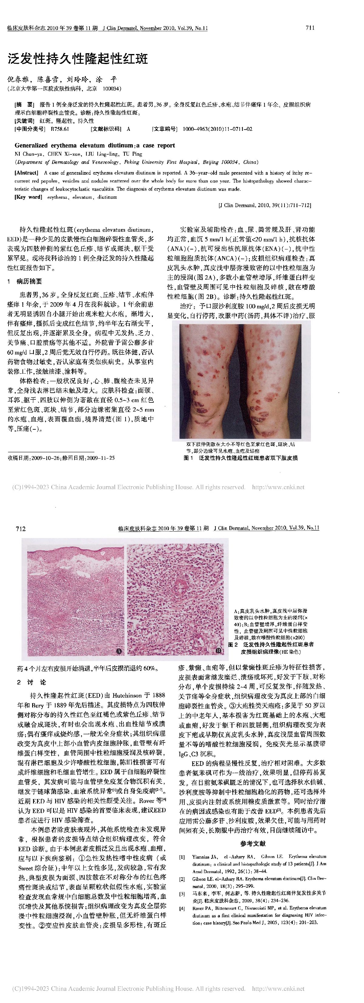 泛发性持久性隆起性红斑