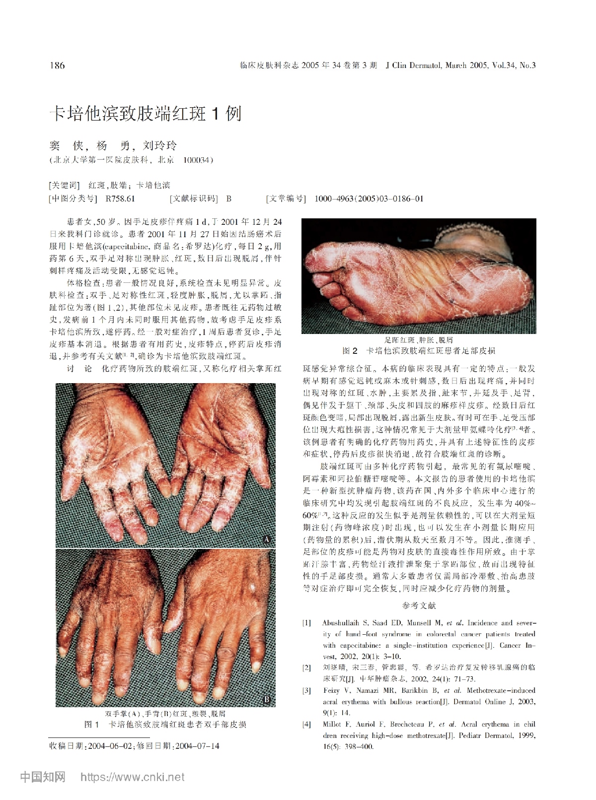 卡培他滨致肢端红斑1例