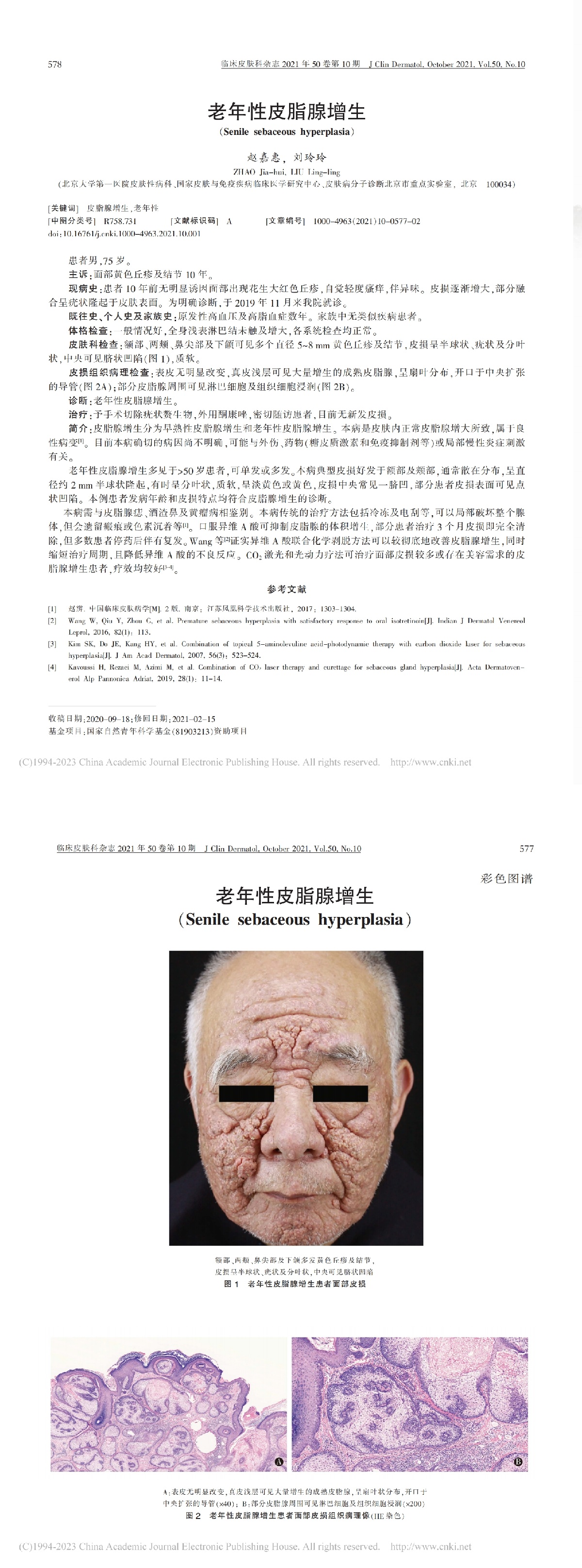 老年性皮脂腺增生
