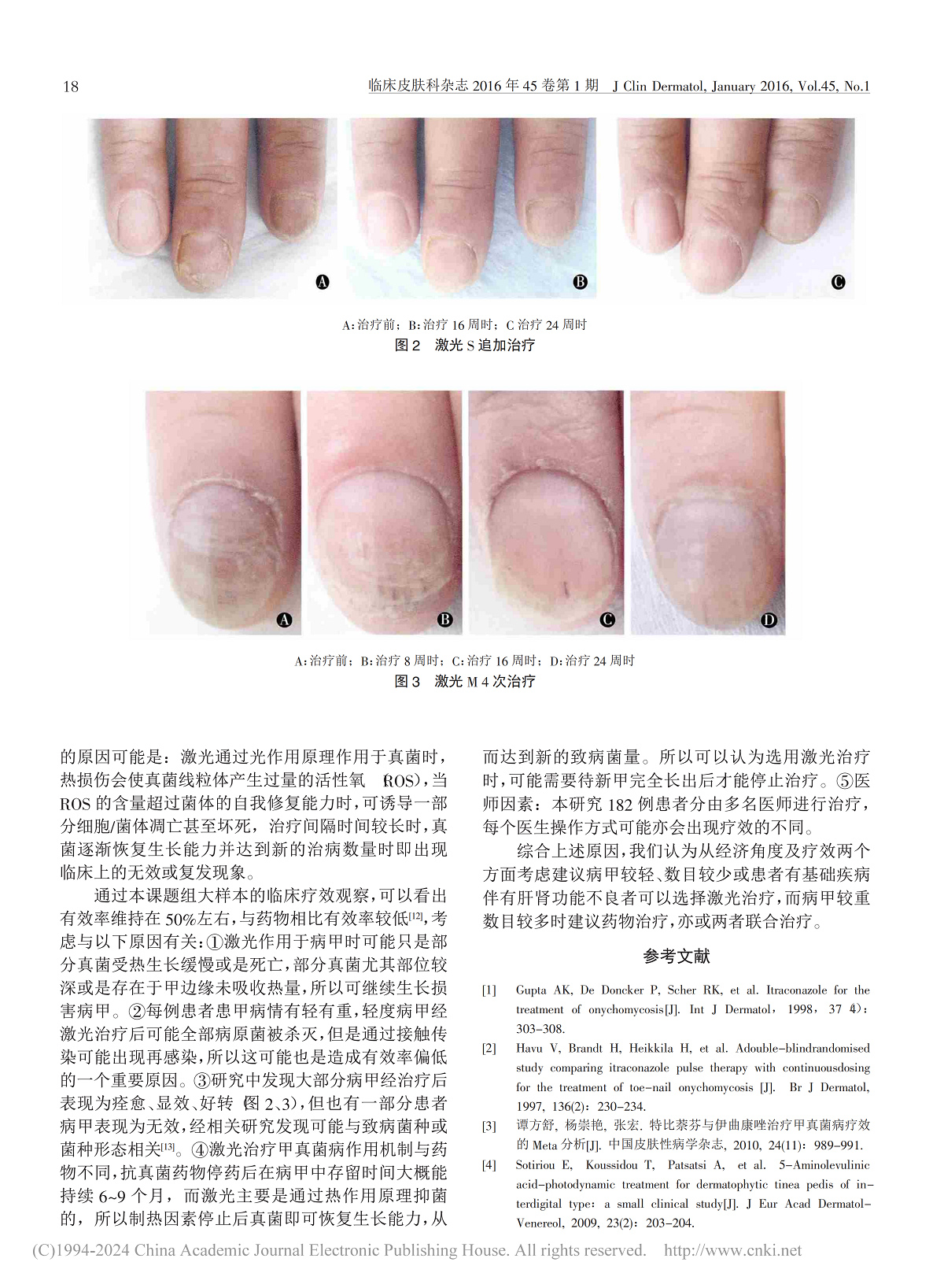 不同激光设备不同方案治疗甲真菌病的疗效评估