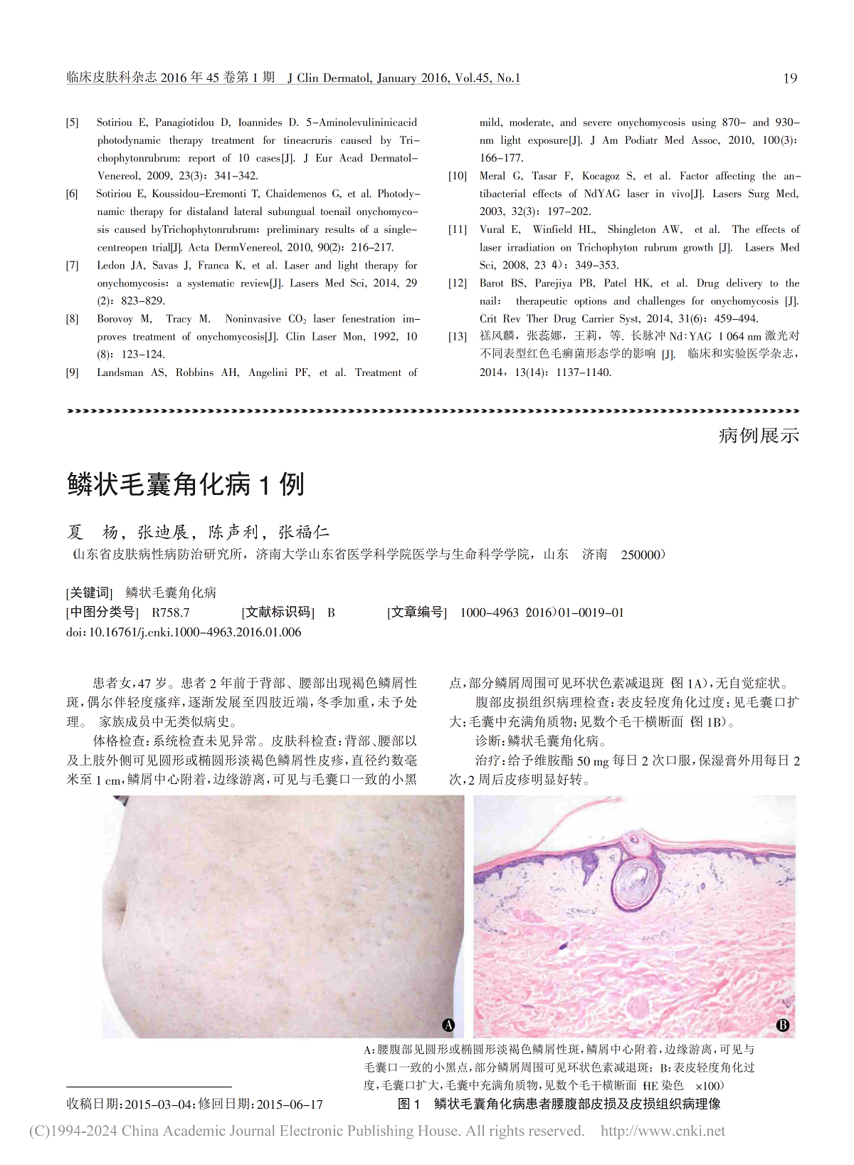 不同激光设备不同方案治疗甲真菌病的疗效评估
