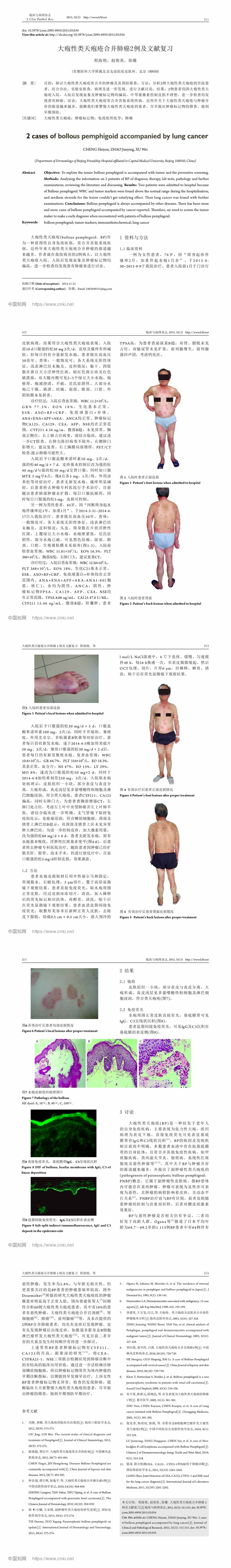 大疱性类天疱疮合并肺癌2例及文献复习