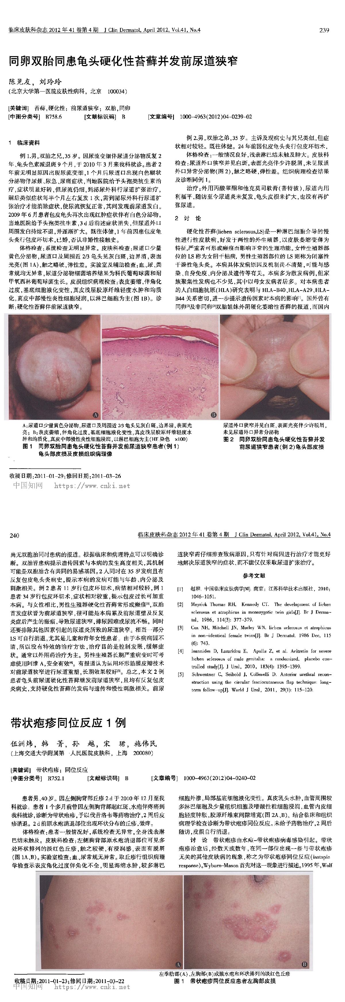 同卵双胎同患龟头硬化性苔藓并发前尿道狭窄