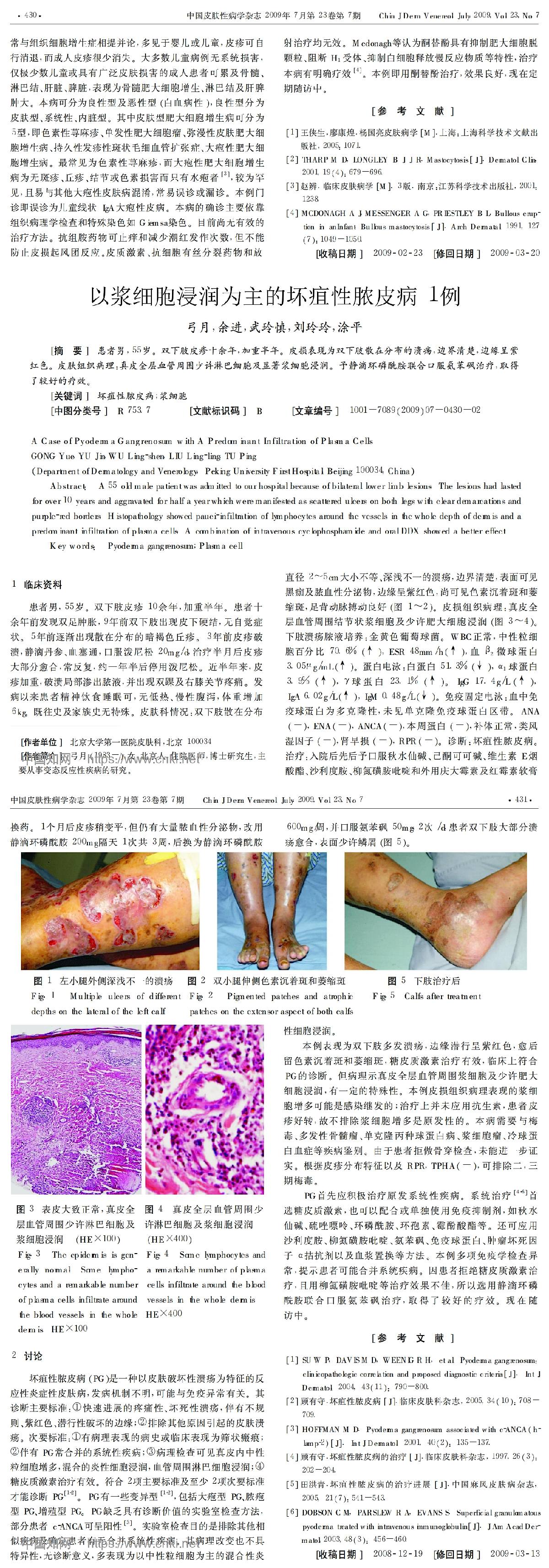 以浆细胞浸润为主的坏疽性脓皮病1例