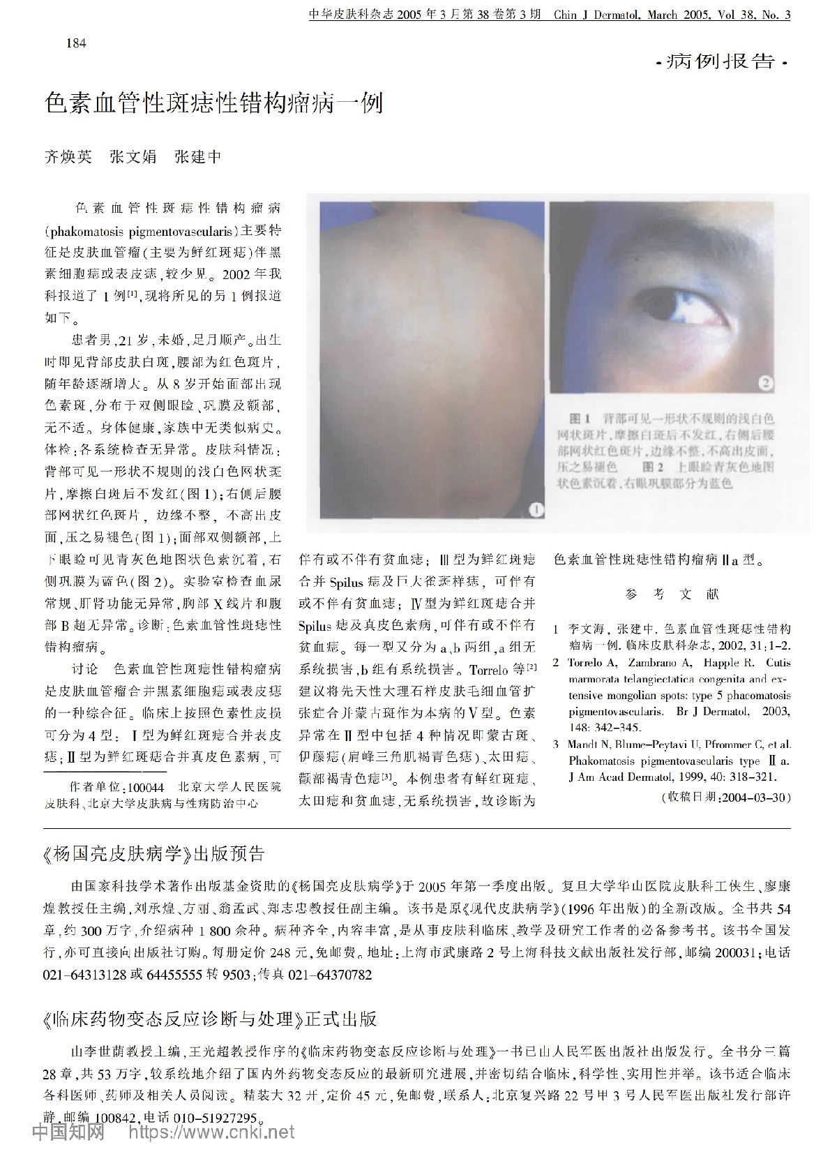 色素血管性斑痣性错构瘤病一例
