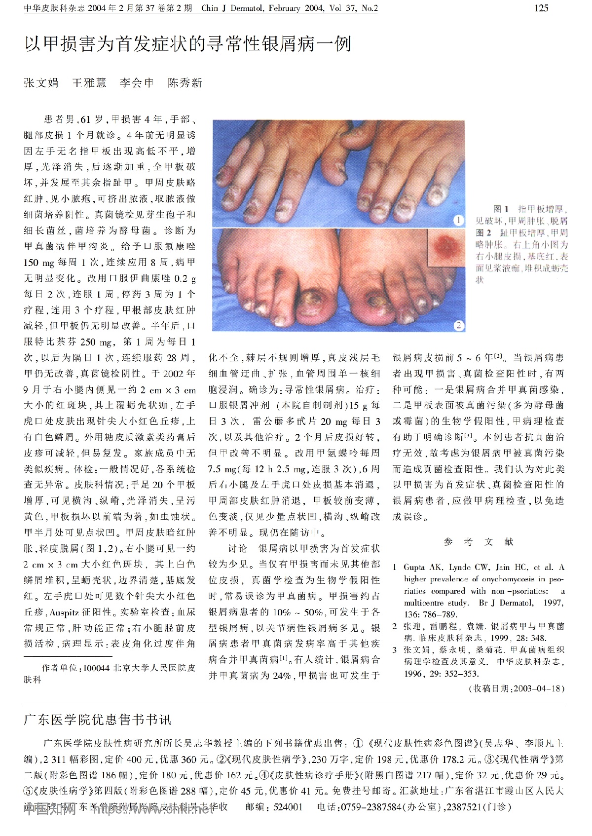以甲损害为首发症状的寻常性银屑病一例