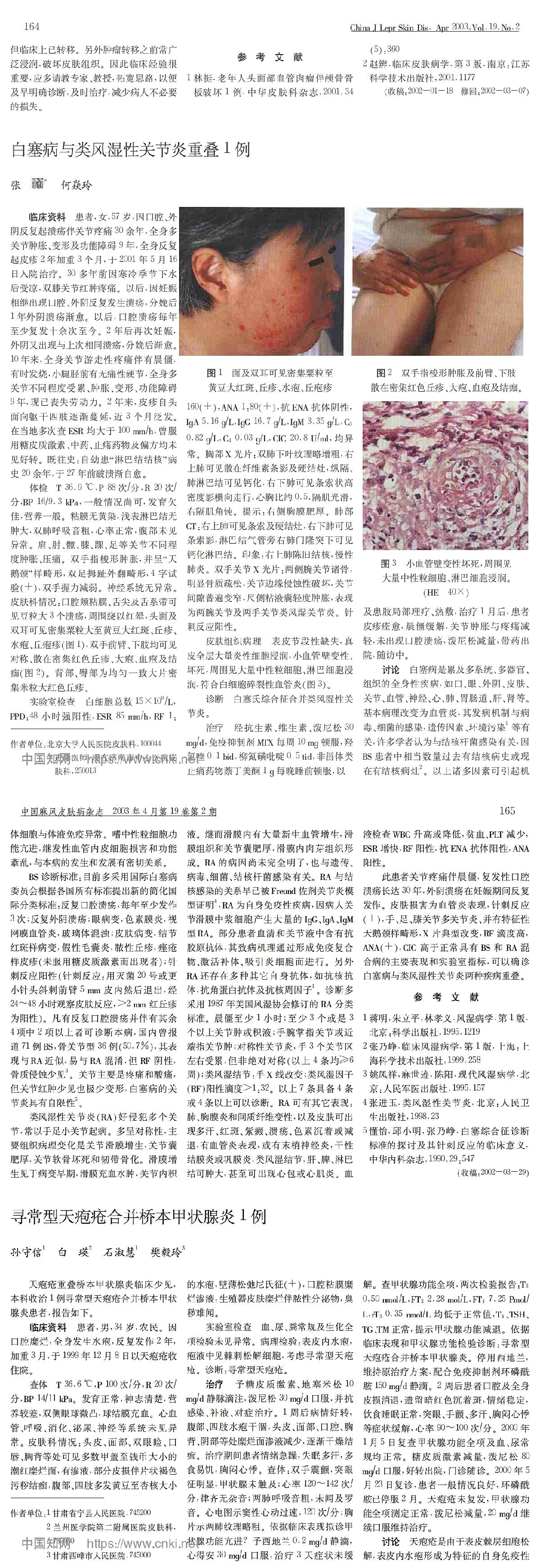 白塞病与类风湿性关节炎重叠1例