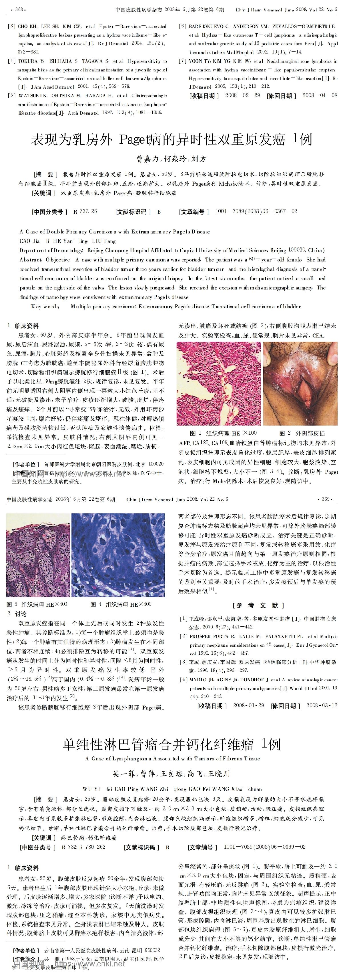 表现为乳房外 Paget病的异时性双重原发癌 1例