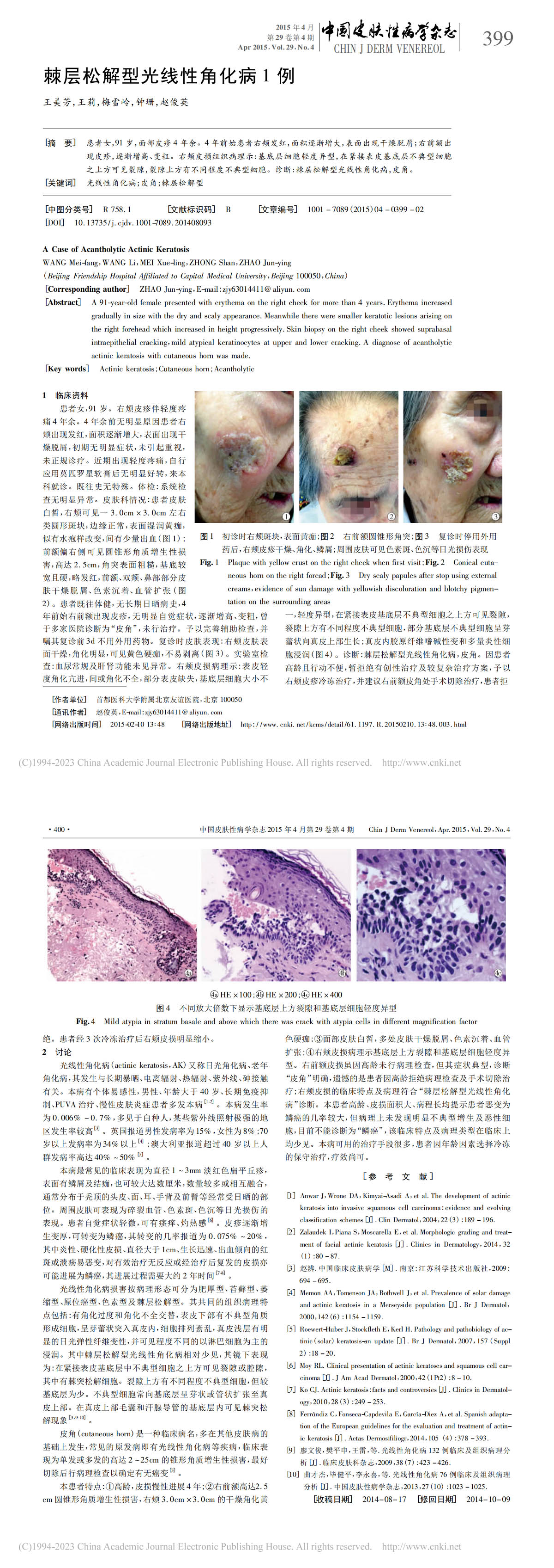 棘层松解型光线性角化病1例