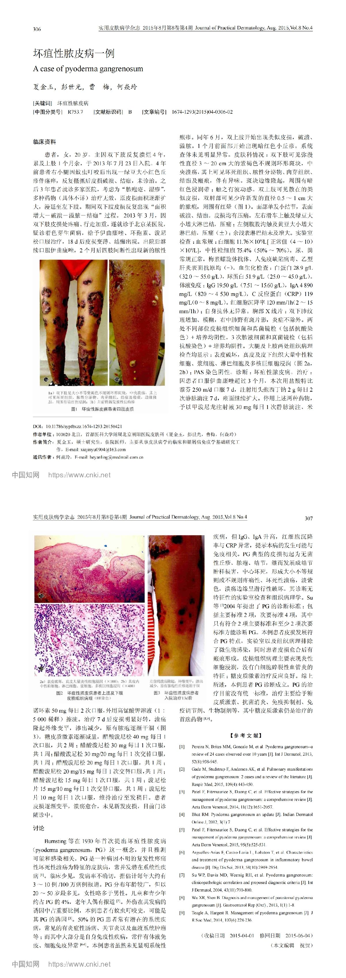 坏疽性脓皮病一例